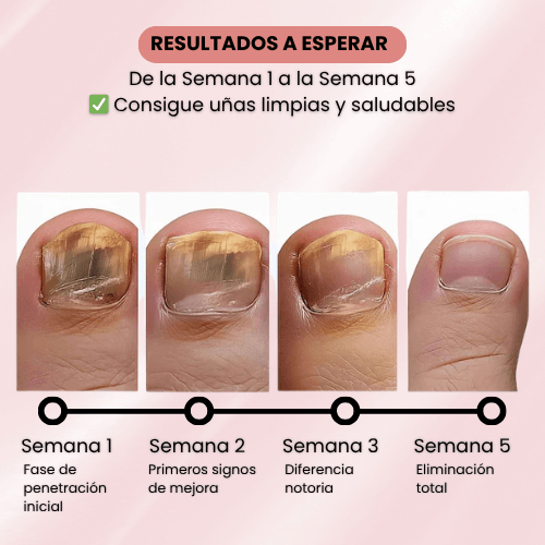 PARCHES ANTI-HONGOS PARA UÑAS